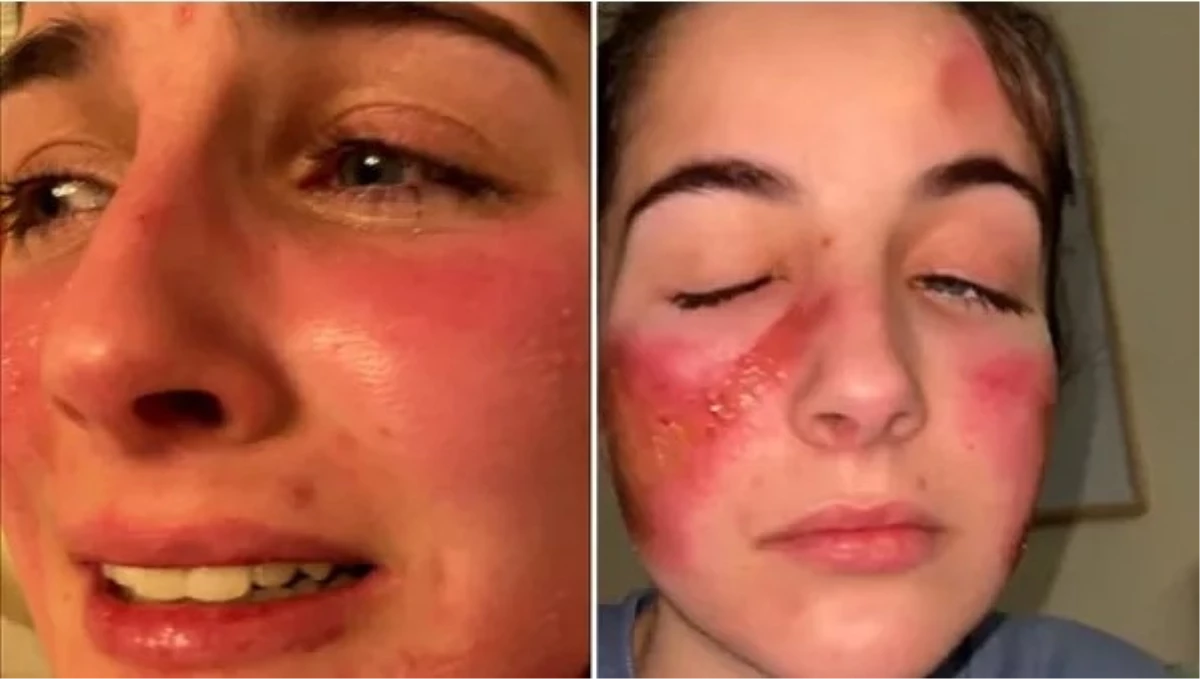 Genç kızın hayatını kabusa çeviren hastalık! Güldüğünde yüzünde yaralar oluşuyor